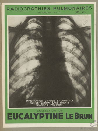 Infiltration diffuse bi-latérale